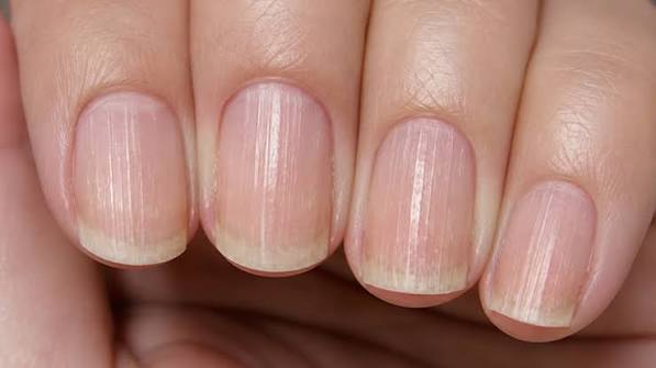 Vì Sao Móng Tay Có Sọc Dọc, Sọc Ngang? Khi Nào Nên Và Không Nên Làm Nail?